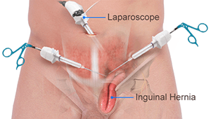 Laparoscopy Hernia Repair